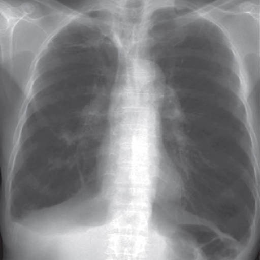 exertional-dyspnea